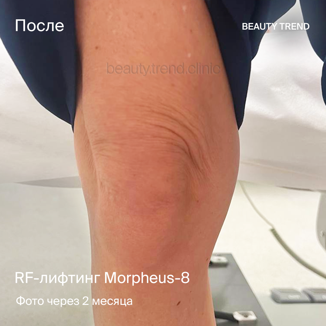 RF-лифтинг morheus 8, 4М - после 1